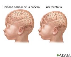 Resultado de imagen de zika y embarazo