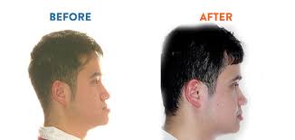 Image result for jaw surgery