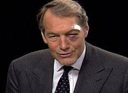 Rose Black Eye. Get Media Alerts. Sign Up. Submit this story. digg reddit stumble. For those of you watching Charlie Rose last night and wondering, ... - s-ROSE-BLACK-EYE-large