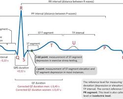 Image of labeled EKG tracing with P wave, QRS complex, T wave, PR interval, QT interval, and ST segment