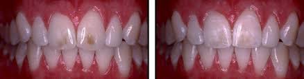 Image result for fluorosis