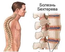 Генетические факторы, связанные с болезнью Бехтерева