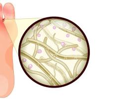 Ayak mantarı belirtileri Athlete's foot symptoms resmi