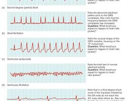 Image of EKG tracings showing different types of arrhythmias