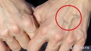 手上青筋暴起，是血管堵塞预警？别忽视这些手部信号，或暗示心脑 ...