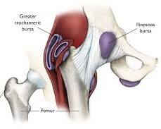 Image of hip bursitis
