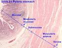 Mesenchymal tumors of muscularis mucosae of colon and rectum