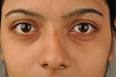 Puffy Eyes - Causes Remedies for Swollen Puffy Eyes