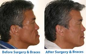 Image result for jaw surgery