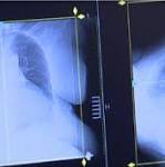  Lung cancer rates in young women raise concerns