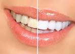 Comment se dtartrer les dents sans passer par la case dentiste