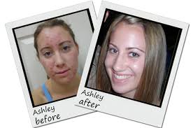 exposed skin care