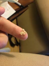 Image result for tonsilith