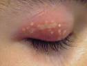 Herpes en ojos, dolorosa infeccin ocular - SyM