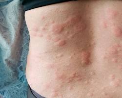 Image of skin irritation