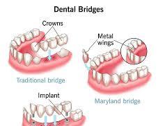 Dental bridge