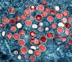 Health advisory issued: NYC reports first case of Mpox Clade I