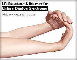 Image result for Ehlers-Danlos