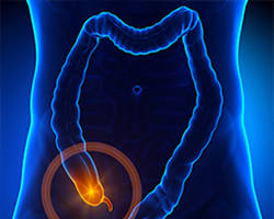 Apandisit ameliyatı resmi