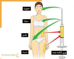 Image of نواحی قابل تزریق چربی