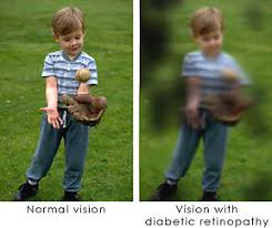 Image result for retinopathy DM