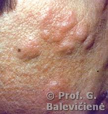 Znalezione obrazy dla zapytania Cysta