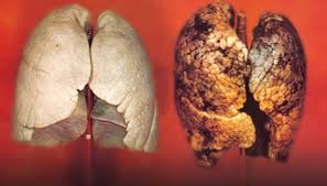 Image result for images of tuberculosis lungs