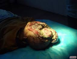 Image result for vibrio vulnificus china
