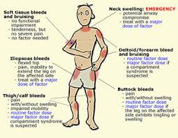 Hemofilia (Hemophilia)