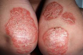 Resultado de imagen de psoriasis codos