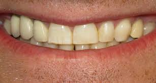 Image result for fluorosis