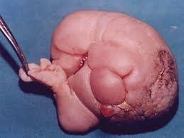 Image result for teratoma