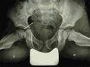 Pathologie de la hanche chez l enfant - Socit Franaise de