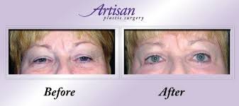 Dr. Francis Johns: Pittsburgh Photo Gallery - johns-pittsburgh-blepharoplasty1