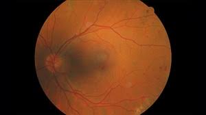 Rising Rates of Diabetic Retinopathy Since 2015: A Critical Study - 1