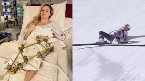 Lindsey Vonn passa por três cirurgias e publica foto no hospital após grave queda de esqui nos Jogos de Inverno