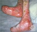 DermIS - Epidermolysis Bullosa Hereditaria (information on the)