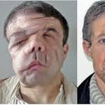  Man with 3 faces: Frenchman gets 2nd face transplant in a medical first