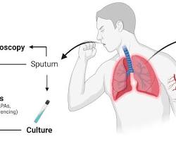 Image of tuberculosis diagnostic methods