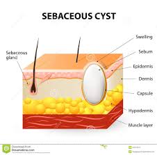 Znalezione obrazy dla zapytania Cysta