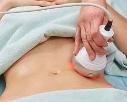 Image of Radiofrequency (RF) body contouring procedure