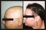 Che cos l alopecia areata - Cause - ANMAA - Associazione