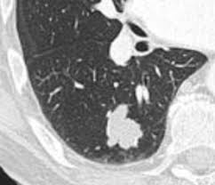 Picture of solitary pulmonary nodule