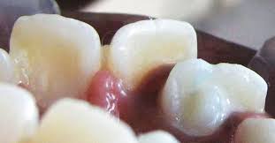 Résultat de recherche d'images pour "shovel shaped incisors"