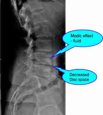 「herniated intervertebral disc  x ray」的圖片搜尋結果
