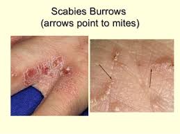 Image result for a scabies