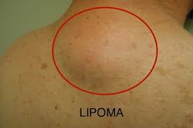 Resultado de imagem para lipoma