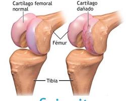 Cartílago articular dañado
