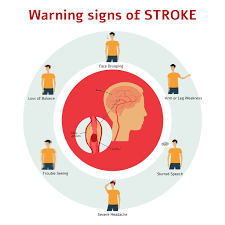 Myomo, Inc. | STROKE ALERT: Don't ignore the signs! An ischemic stroke occurs when a blood vessel supplying the brain gets blocked and a hemorrhagic... | Instagram