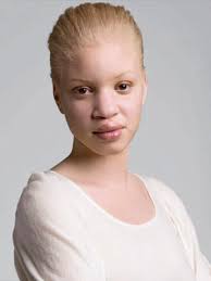 albino black person - Kenosha Robinson - people with albinism - Marie Claire - mcx0707BESkin004-new-md